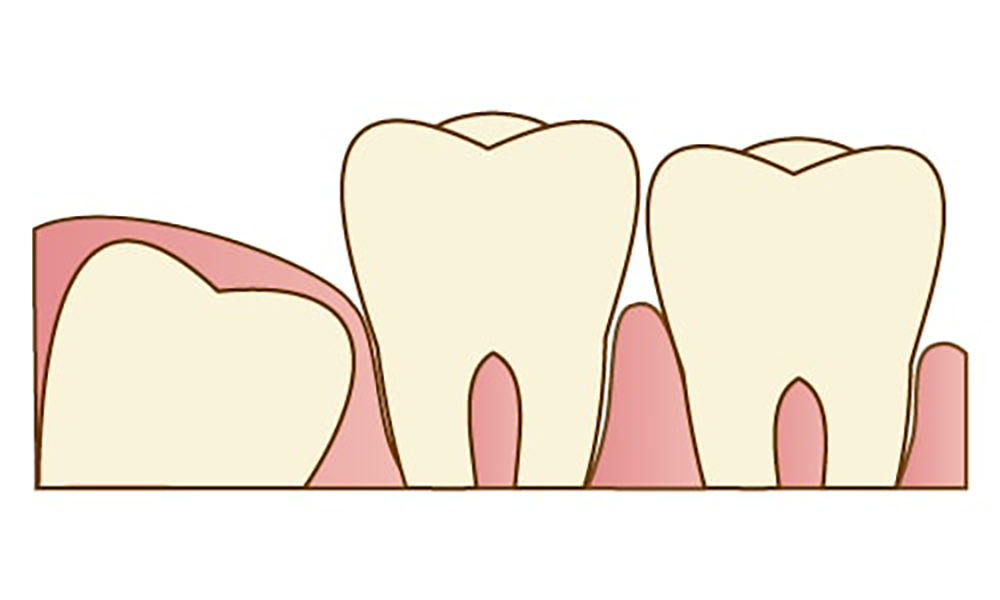親知らずについて