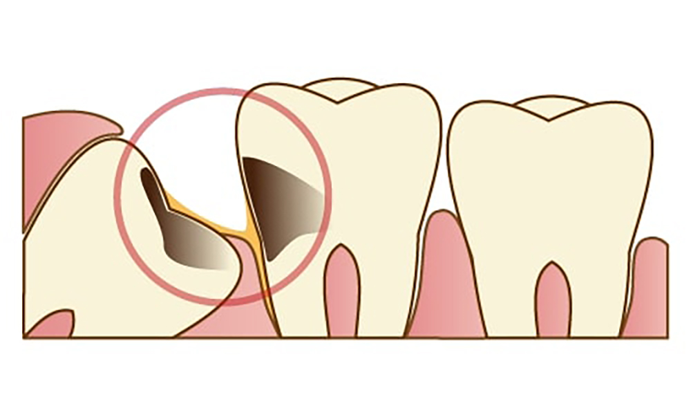 腫瘍や囊胞(のうほう)の原因に