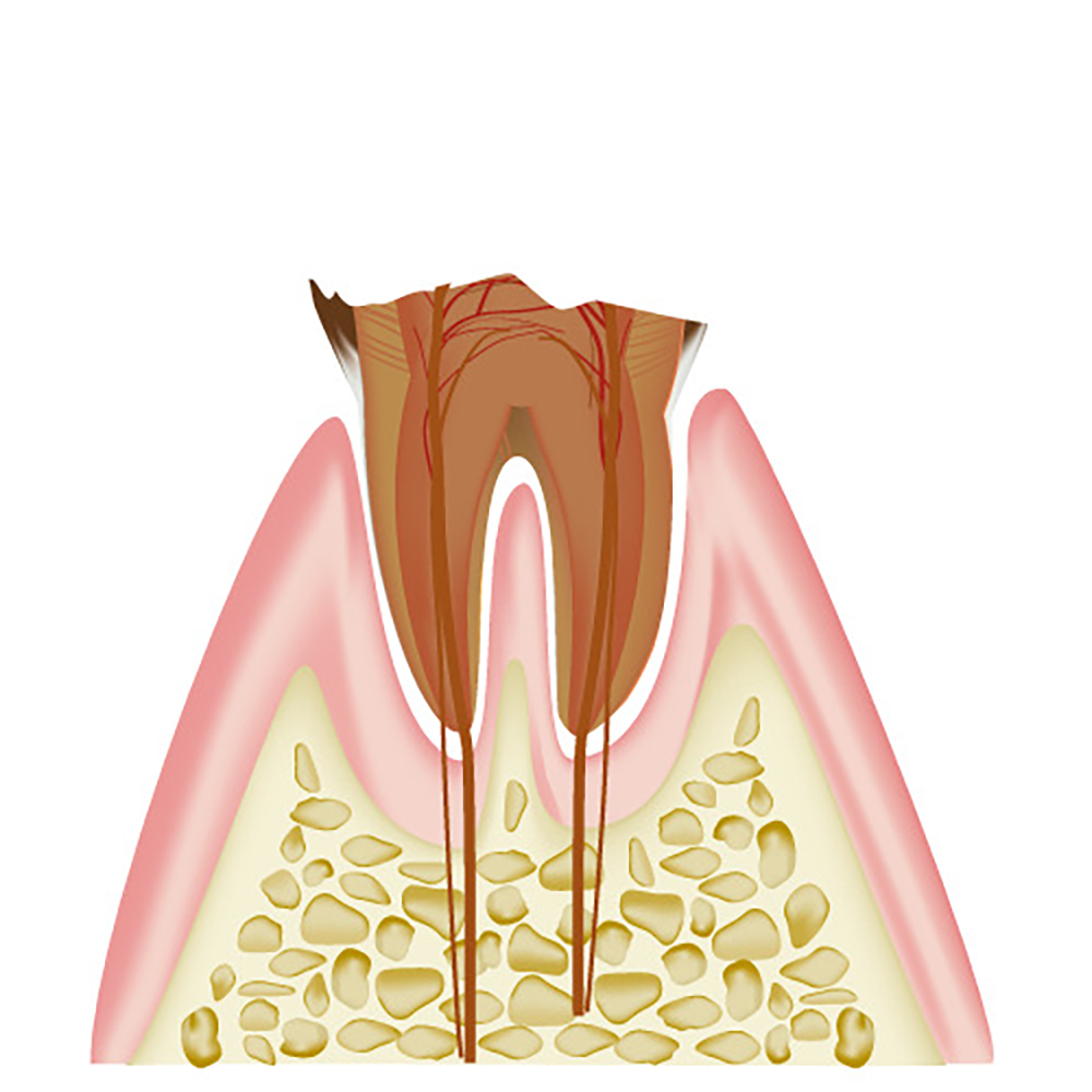 さらに進行すると熱いものもしみて痛みます
