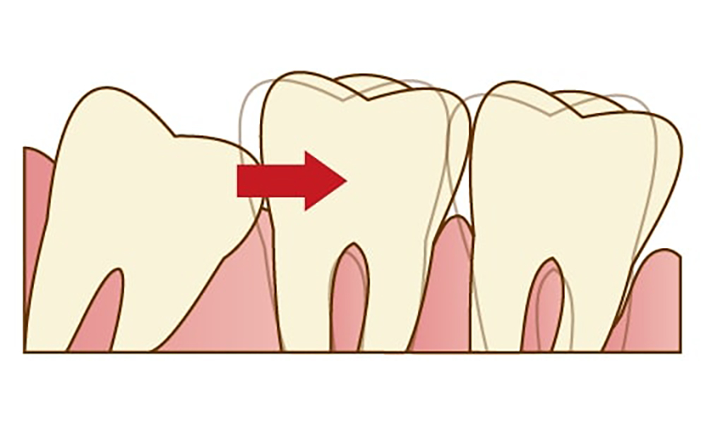 歯並びが悪くなってしまうことも