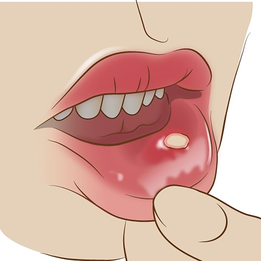 口腔がんについて