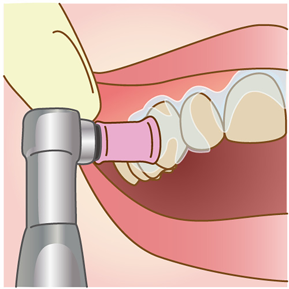 歯の表面にジェルを塗布